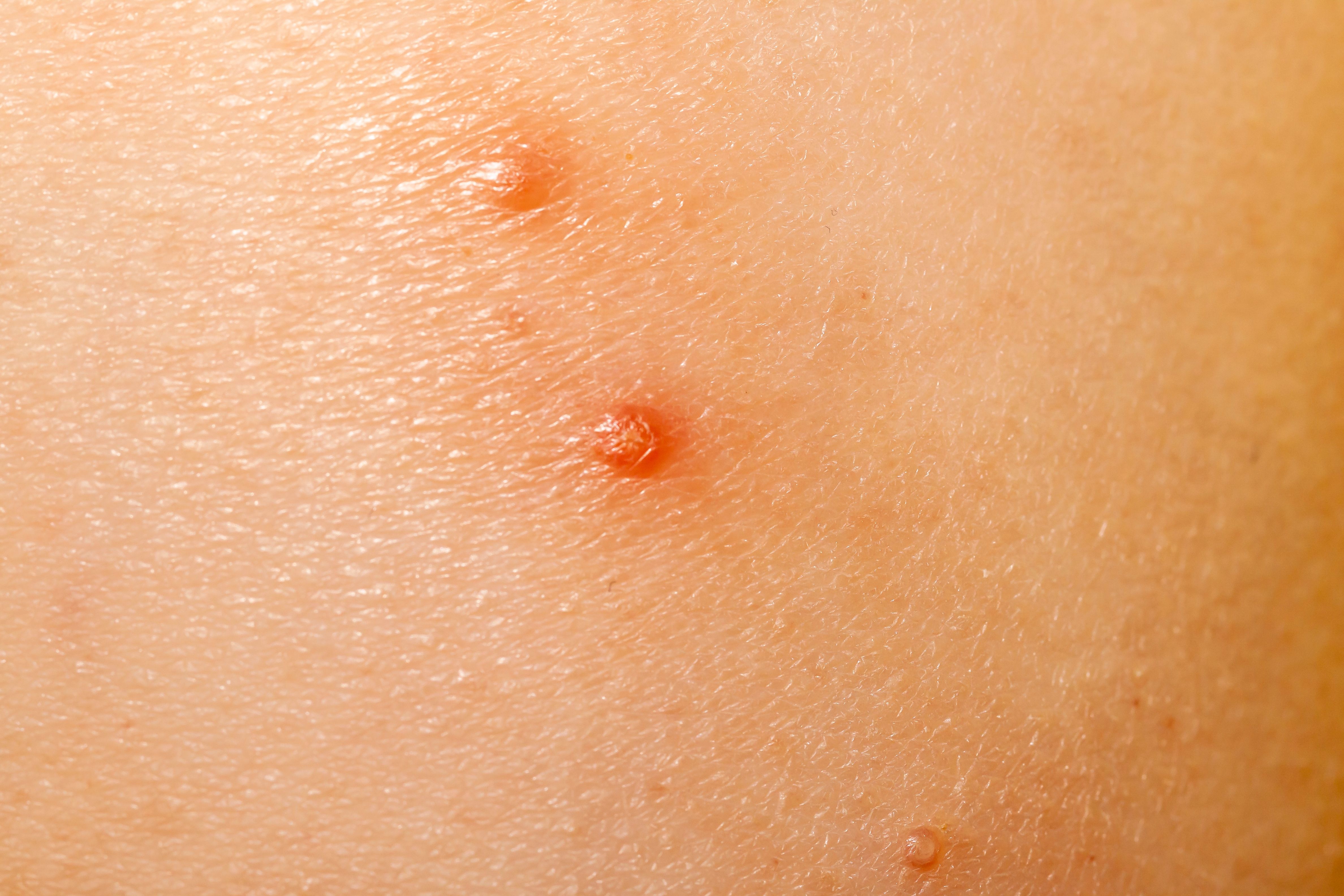Berdamizer Gel Safe, Well-Tolerated in Patients With Molluscum ...