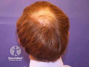 Clascoterone 5% Delivers Strong Phase 3 Hair-Growth Results