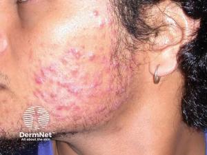 Clear Health Launches Topical Isotretinoin Acne Treatment Without iPLEDGE Requirements