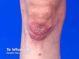  Psoriasis Resolution in a Patient Treated With CD19 CAR T-Cell Therapy for Refractory DLBCL