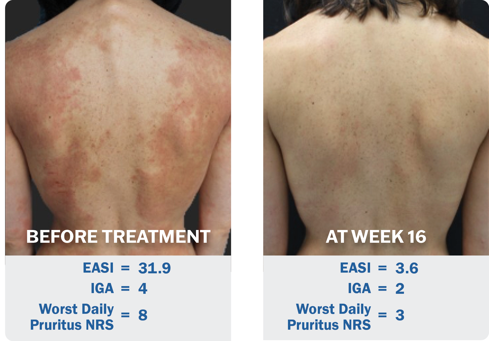 Example improvement in EASI from baseline to Week 16 in patient receiving Adbry in ECZTRA 2. Individual results may vary.