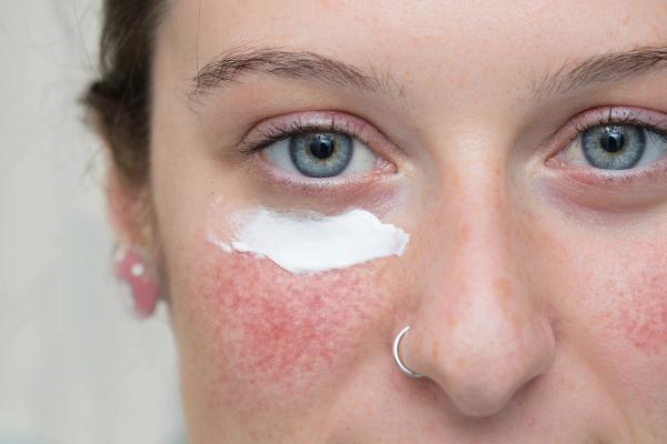Novel Botanical Moisturizer Demonstrates Superior Efficacy Over Metronidazole in Phase 2 Rosacea Trial