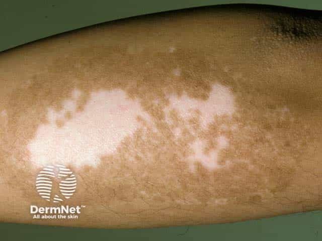 New Meta-Analysis Supports Targeted Vitiligo Therapies