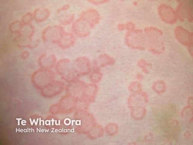 First Biologic for Pediatric CSU Approved: Here's What It Means for Your Patients