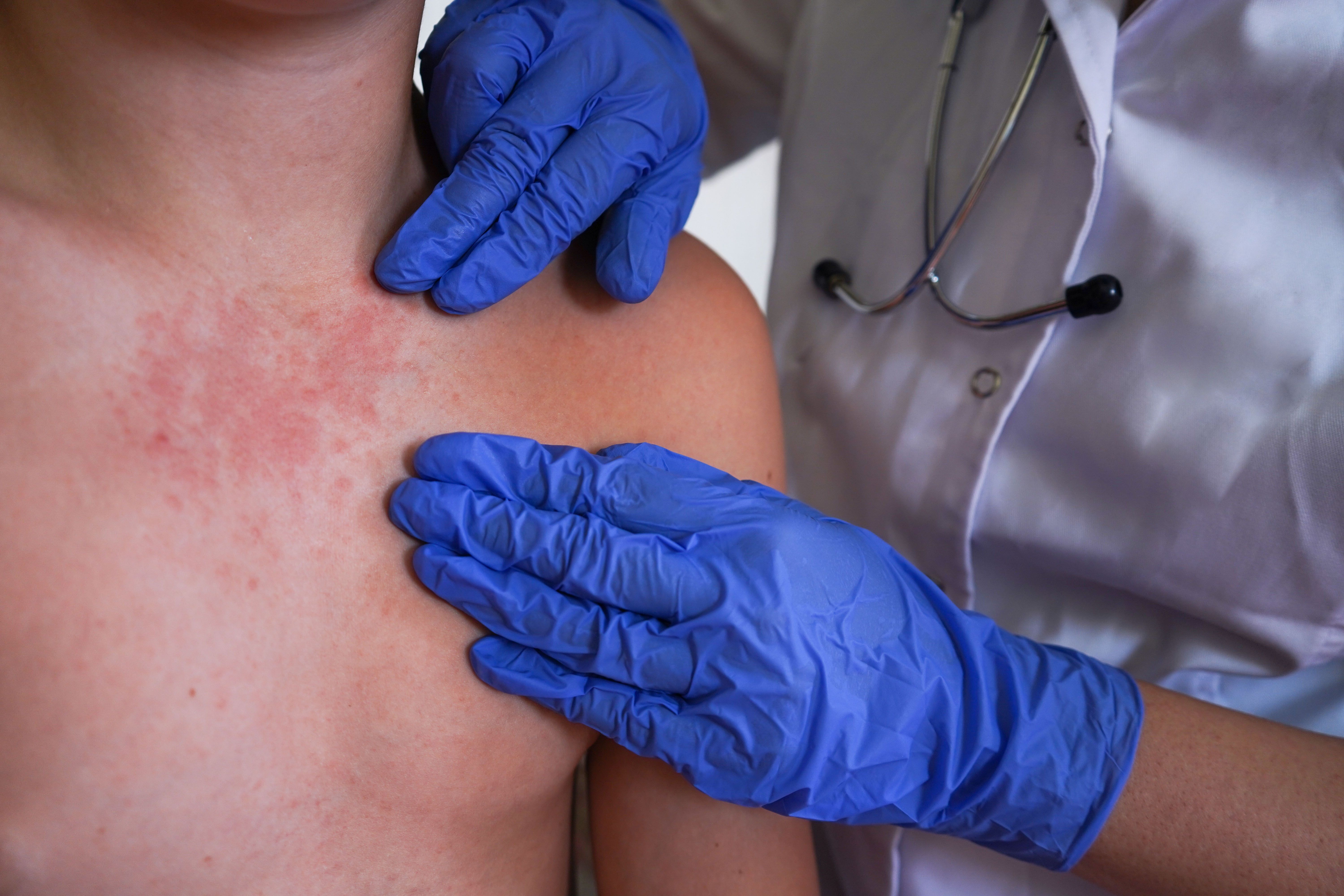 <![CDATA[Assessing the Global Impact of Chronic Spontaneous Urticaria on Family and Caregivers]]>