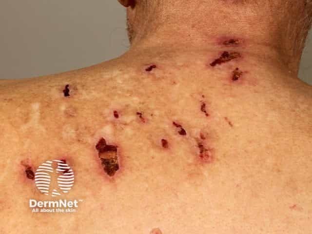 Virtual Therapy Shows Promise for Dermatological Body-Focused Repetitive Behaviors