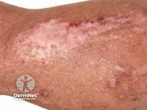 Disease-Modifying Topicals Redefine Atopic Dermatitis Management