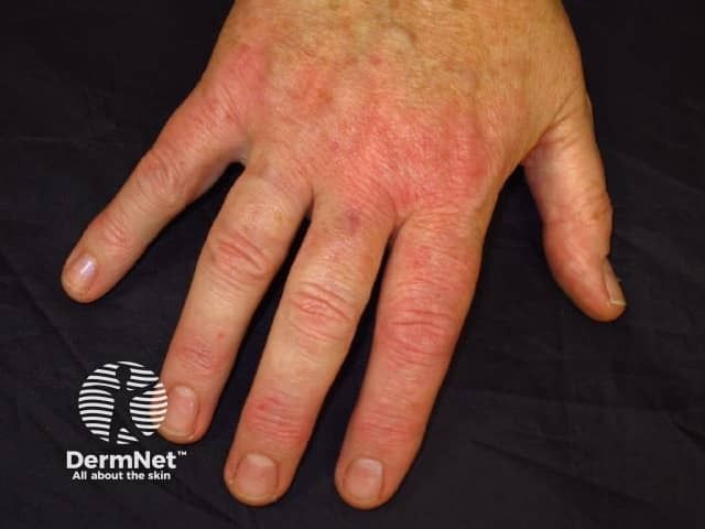 Tralokinumab Shows Hand Relief in ADHAND Trial