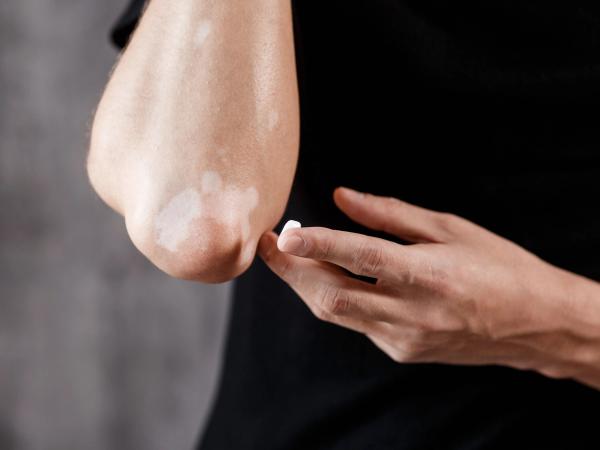 Noninvasive Imaging Maps Repigmentation and Melanocyte Activation in Ruxolitinib-Treated Vitiligo