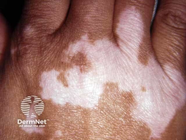 Clinical Characteristics and Management of Late-Onset Vitiligo