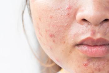 Acne: Therapeutic Updates and Our Most Challenging Cases