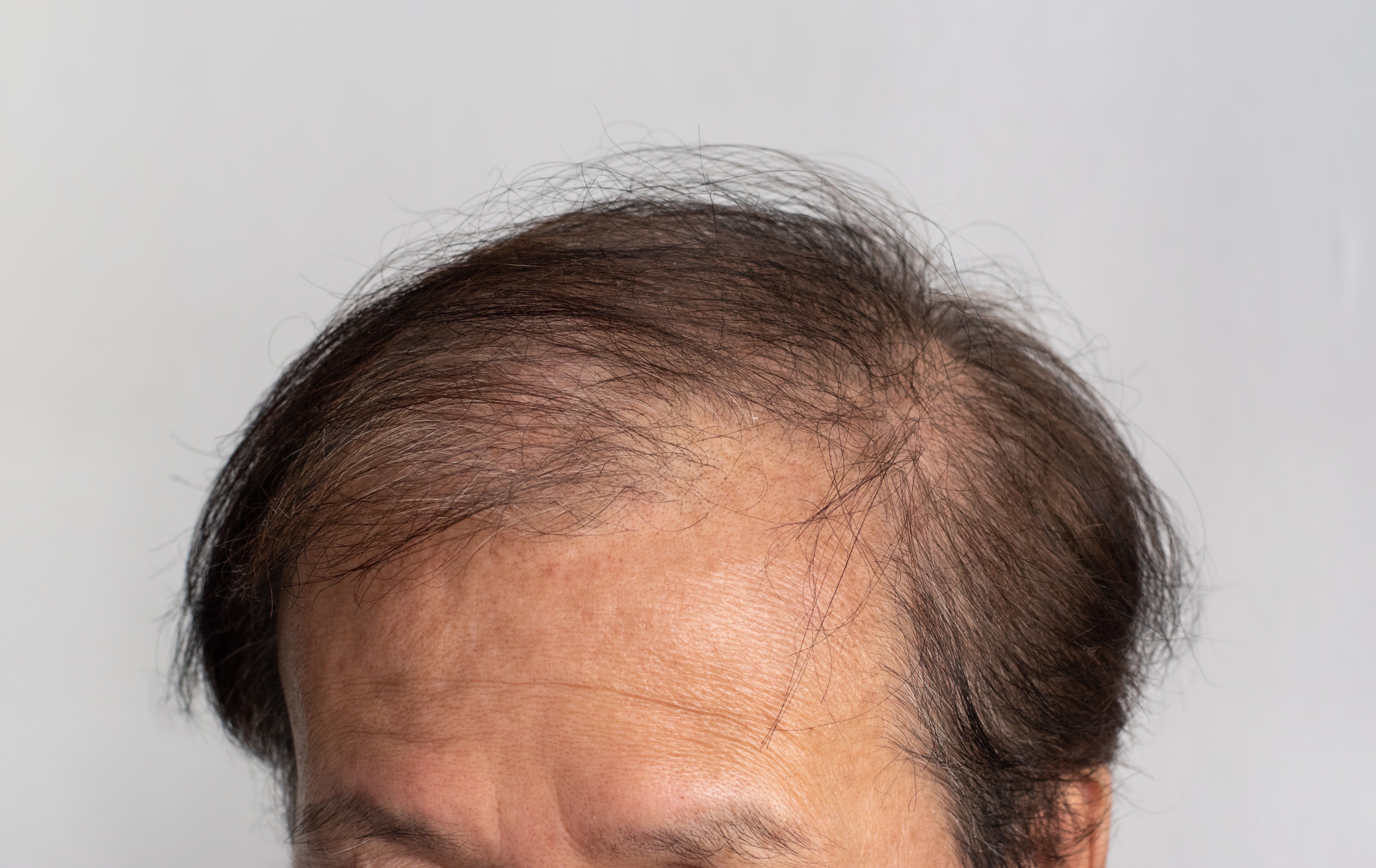  ICYMI: Eirion ET-02’s Successful Phase 1 Trial Results for Androgenic Alopecia Treatment