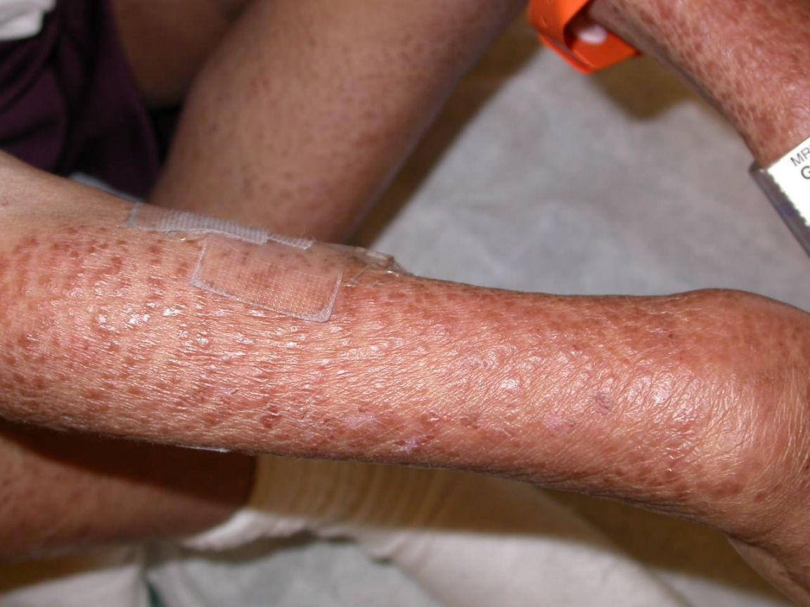 Multiple, reddish-brown papules coalesced over the right arm in a boy with Blau syndrome. Photo courtesy: Donald A Glass II MD, PhD, Jennifer Maender MD, Denise Metry MD/Dermatology Online Journal