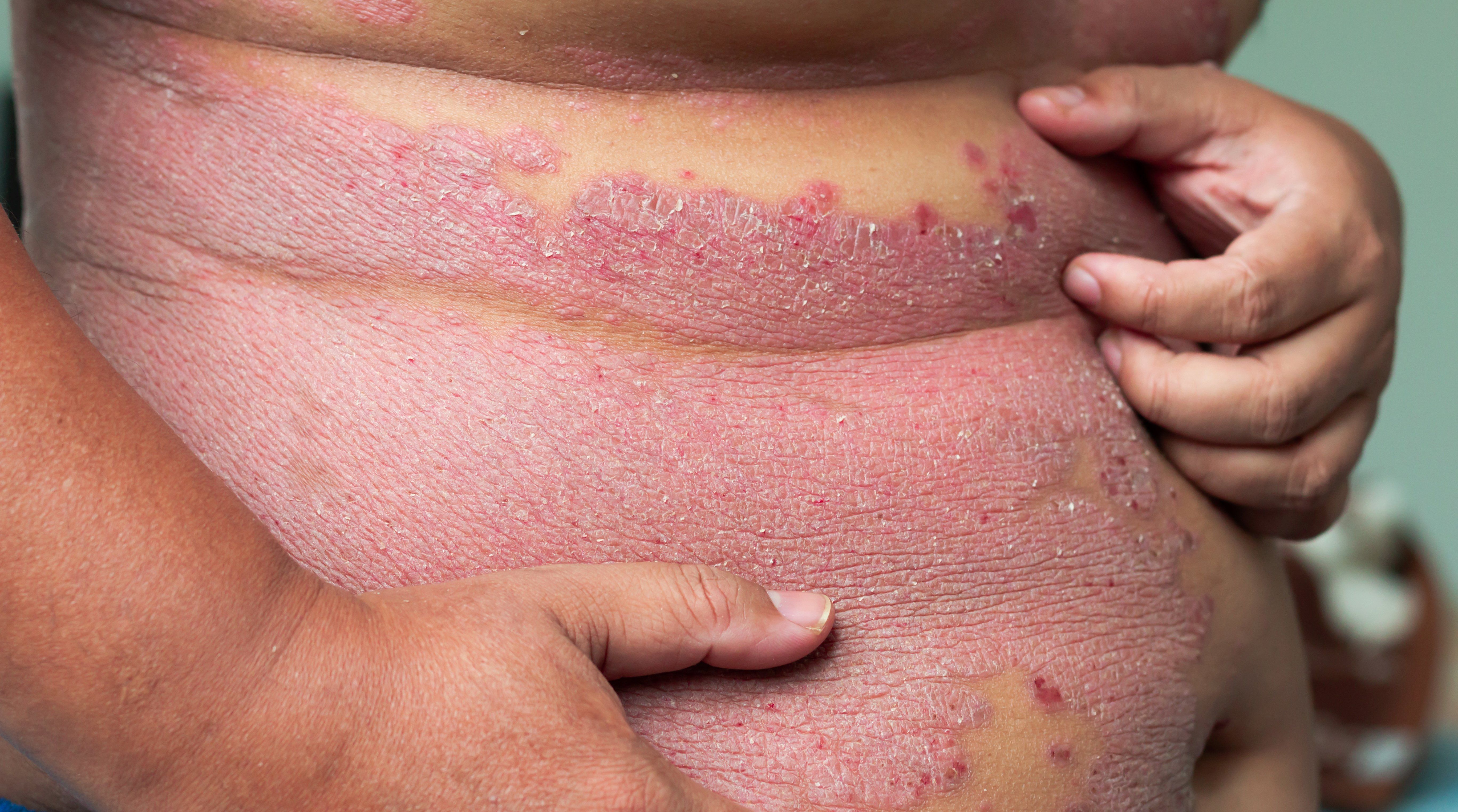 connection between psoriasis and crohns disease