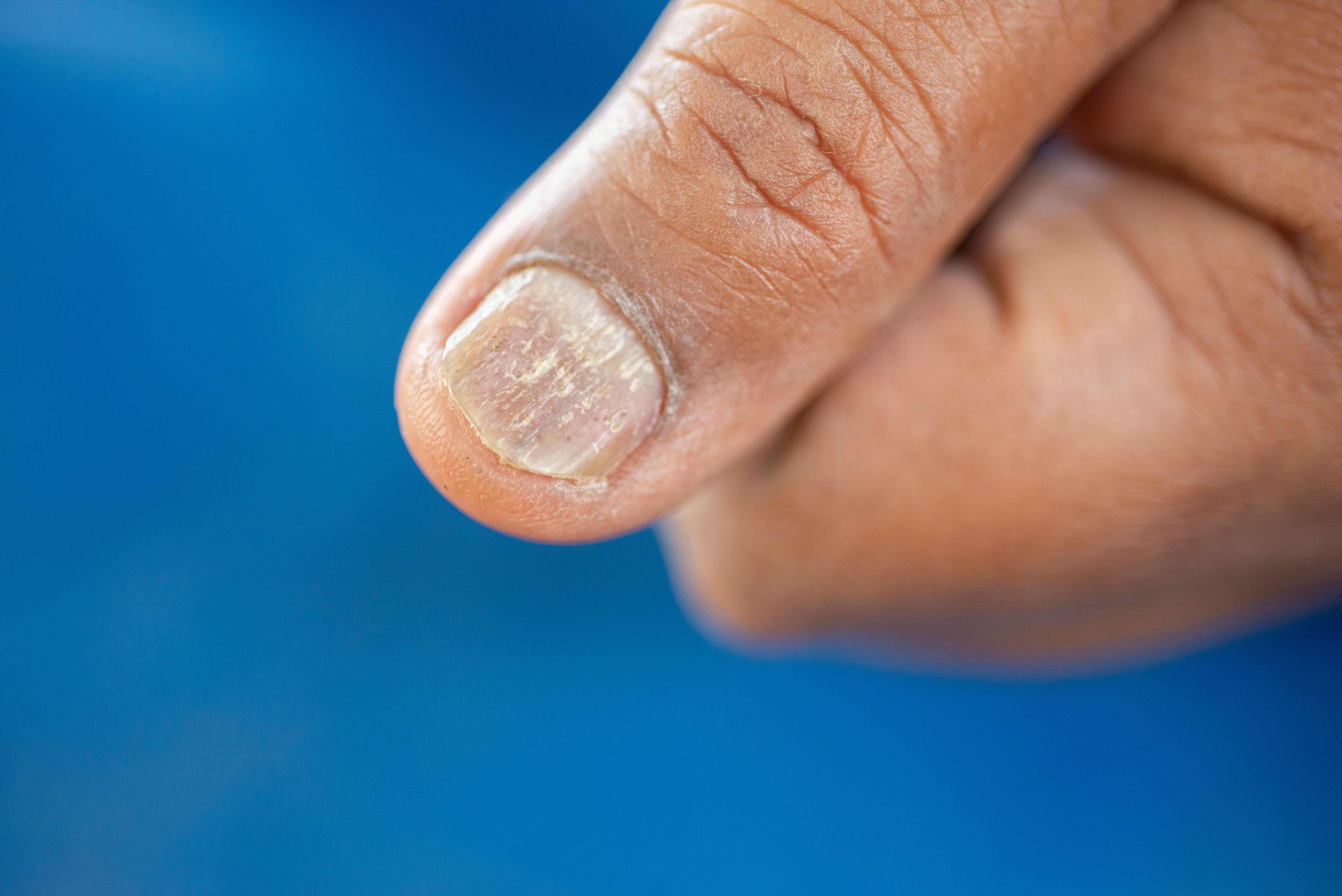 5 Causes of White Spots on Nails (With Images) - GoodRx