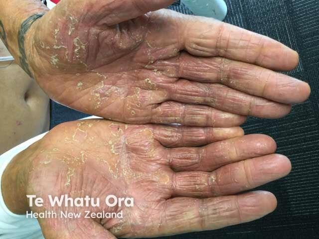 Delgocitinib Cream Shows Minimal Systemic Absorption in CHE