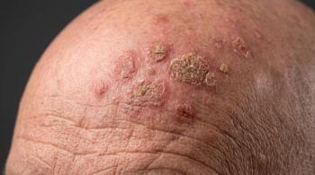 Biofrontera Submits sNDA to Expand Ameluz PDT for Actinic Keratoses Across the Body