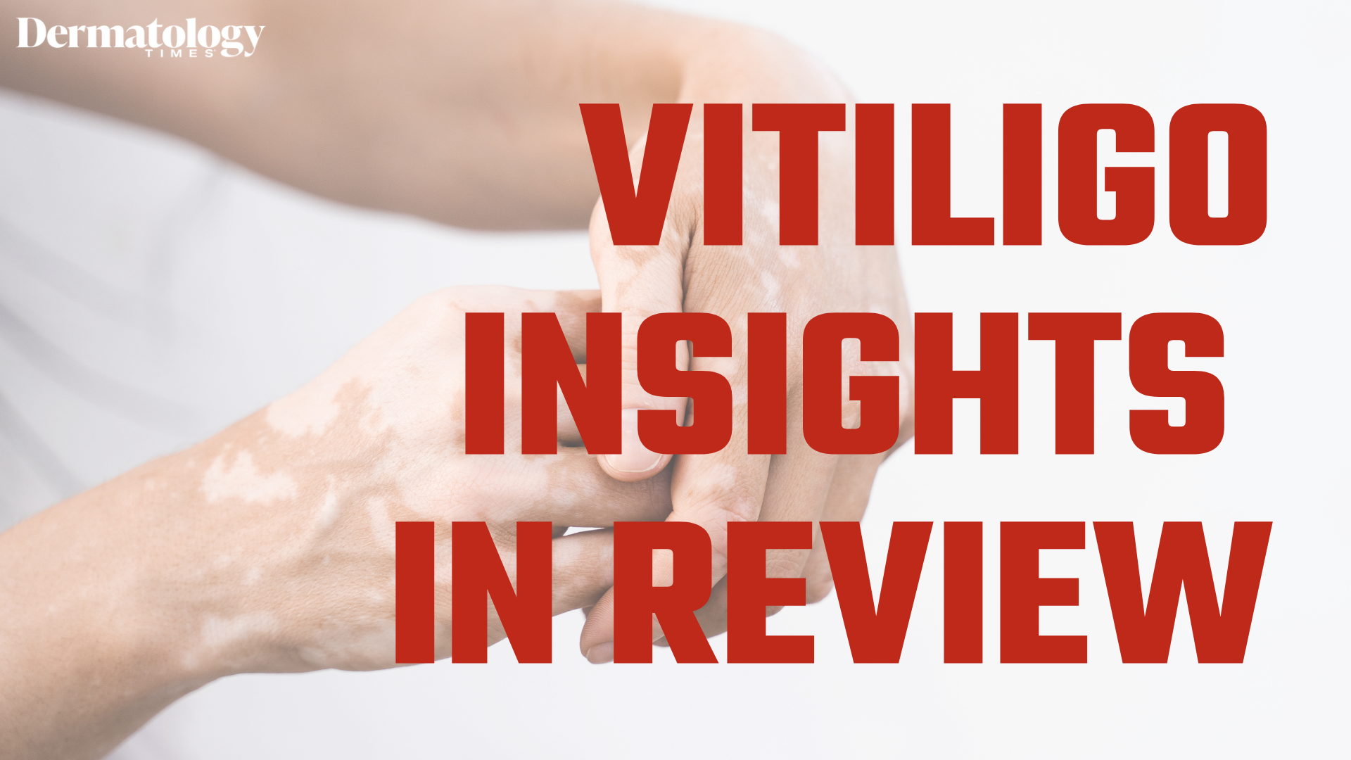 Reviewing Key Clinician Insights and Innovations in Vitiligo Care This Year