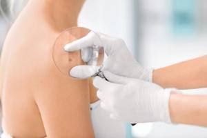 Role of Precision Medicine in the Management of Melanoma