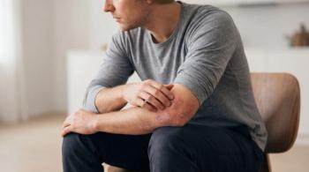 Avoiding Common Mistakes When Escalating Therapy in Psoriasis