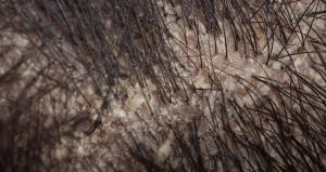 macro view of hair root or scalp with dandruff, seborrheic dermatitis