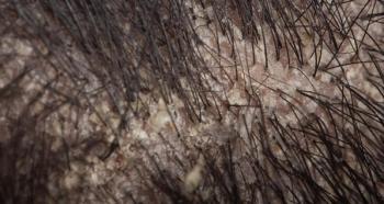 macro view of hair root or scalp with dandruff, seborrheic dermatitis