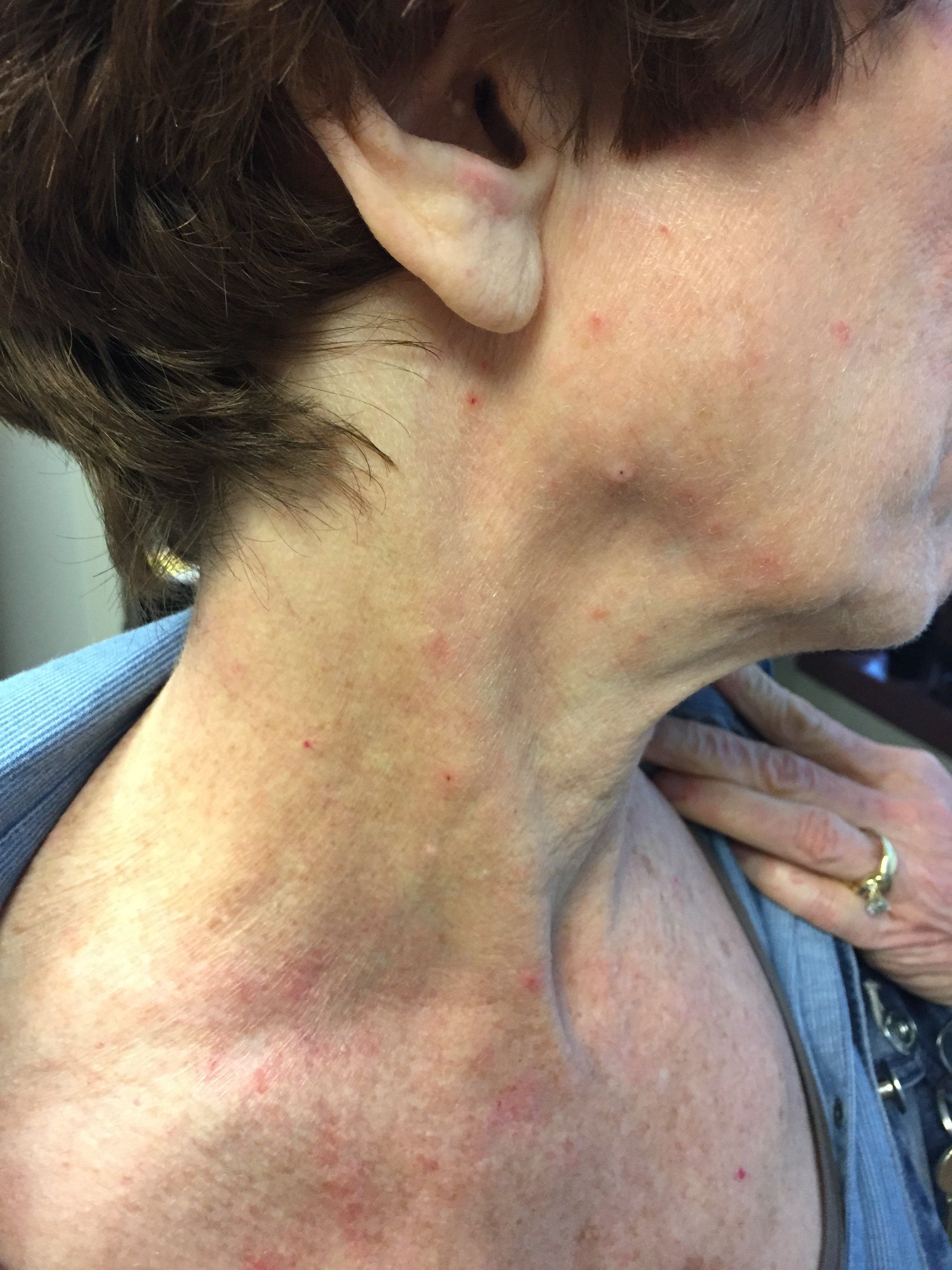 eczema on neck