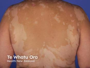 EB06 Phase 2 Vitiligo Study Receives FDA IND Clearance