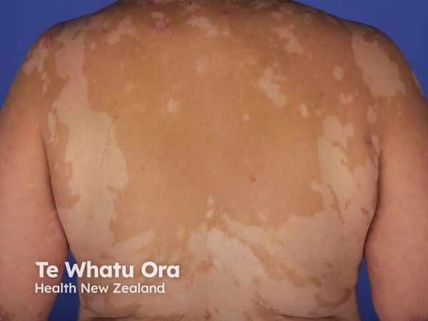 EB06 Phase 2 Vitiligo Study Receives FDA IND Clearance