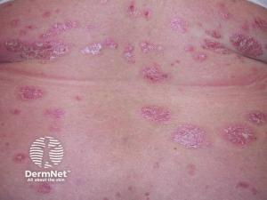 New-Onset Psoriasis After Abrocitinib Treatment for Atopic Dermatitis 