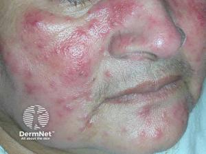 Rosacea Uncovered: Current Practices and Therapies on the Horizon