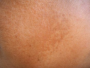 melasma