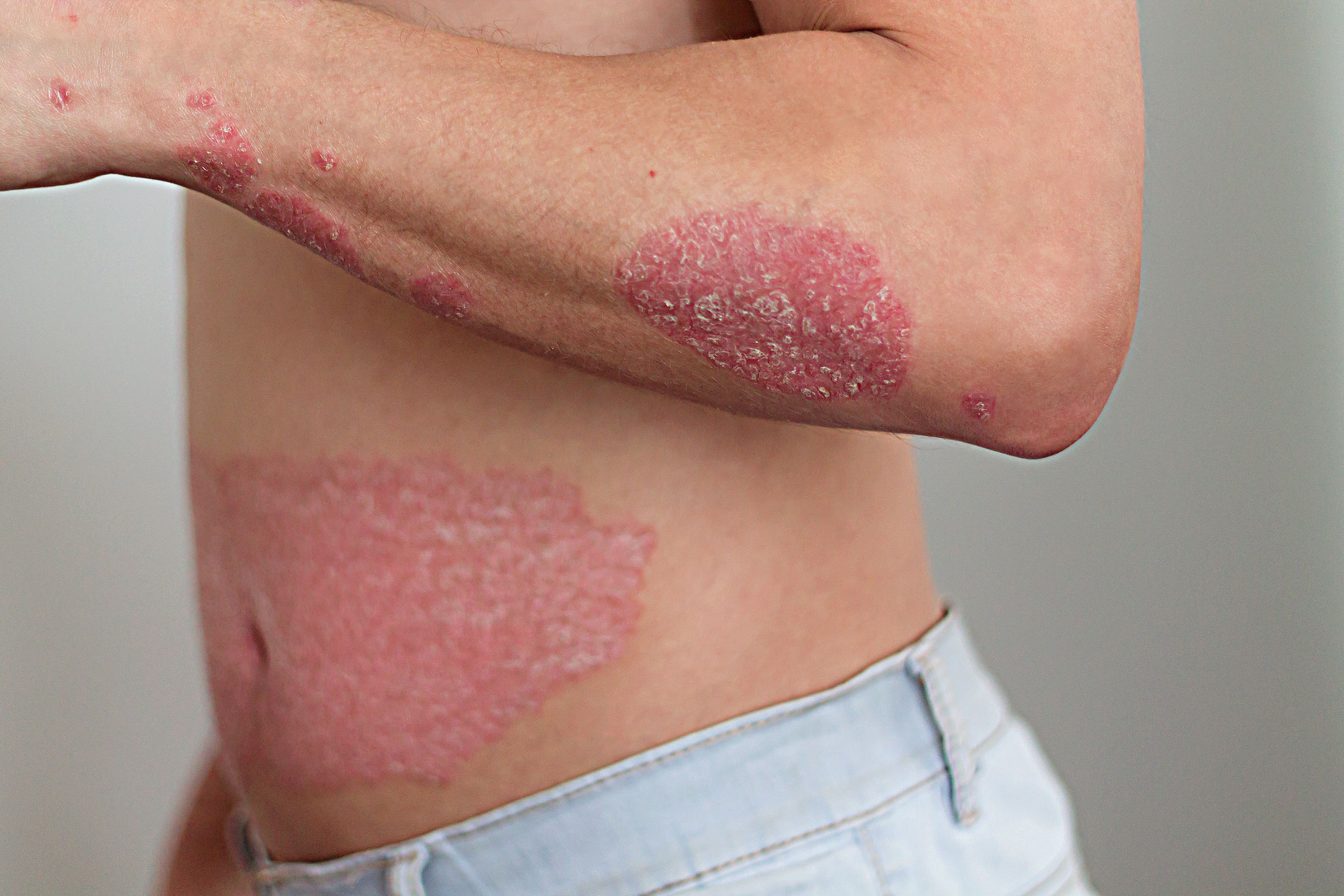 Genetic Changes in Psoriasis Patients Clear, but Carry Uncertain Consequences
