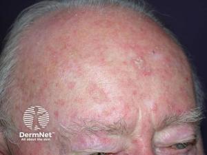 actinic keratosis