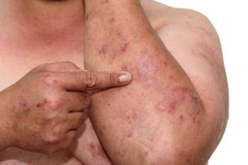 Psoriasis 3 (©SweetheartStudioShutterstock.com)