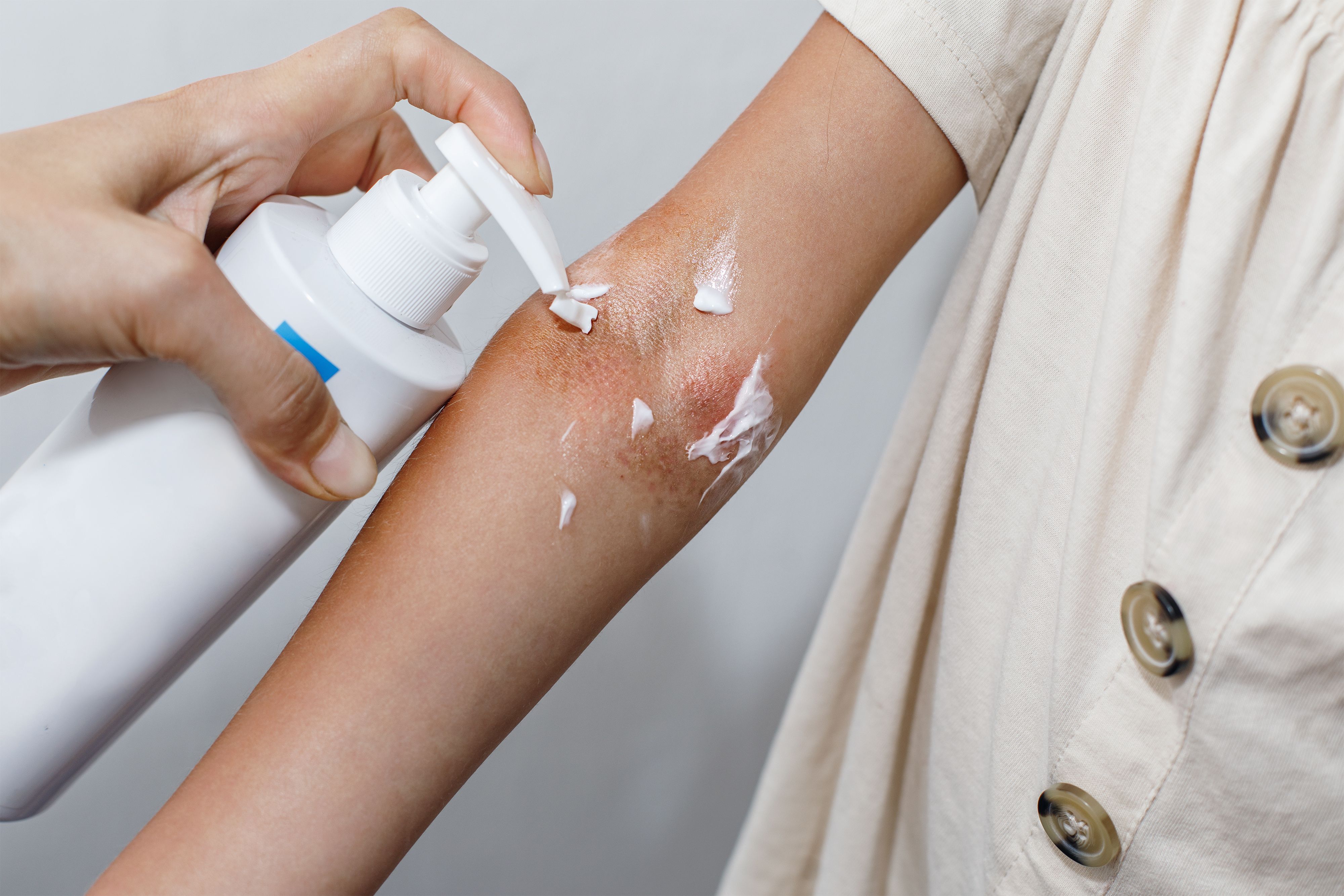 The Impact of Anti-Inflammatory Moisturizers in Mild to Moderate Atopic Dermatitis Treatment