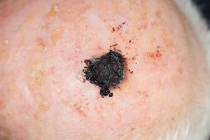 Expert Panel Unanimously Backs DecisionDx-Melanoma for Guiding Personalized Cancer Care