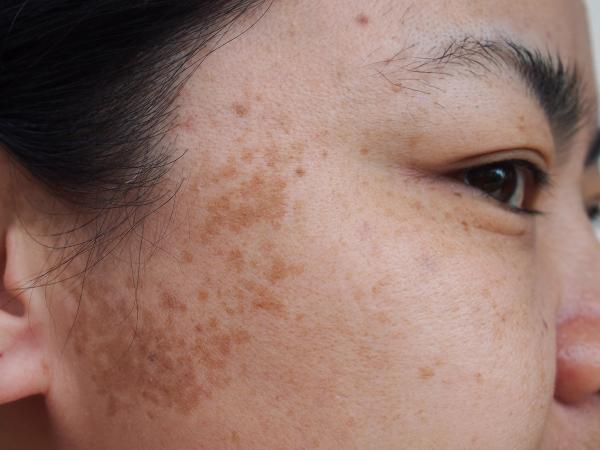 AI-Assisted Imaging Tracks Success of Low-Fluence QSRL Laser for Melasma