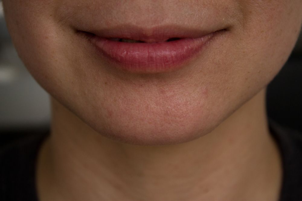 vermilion-lip-carcinoma-five-times-more-sensitive-to-metastasis