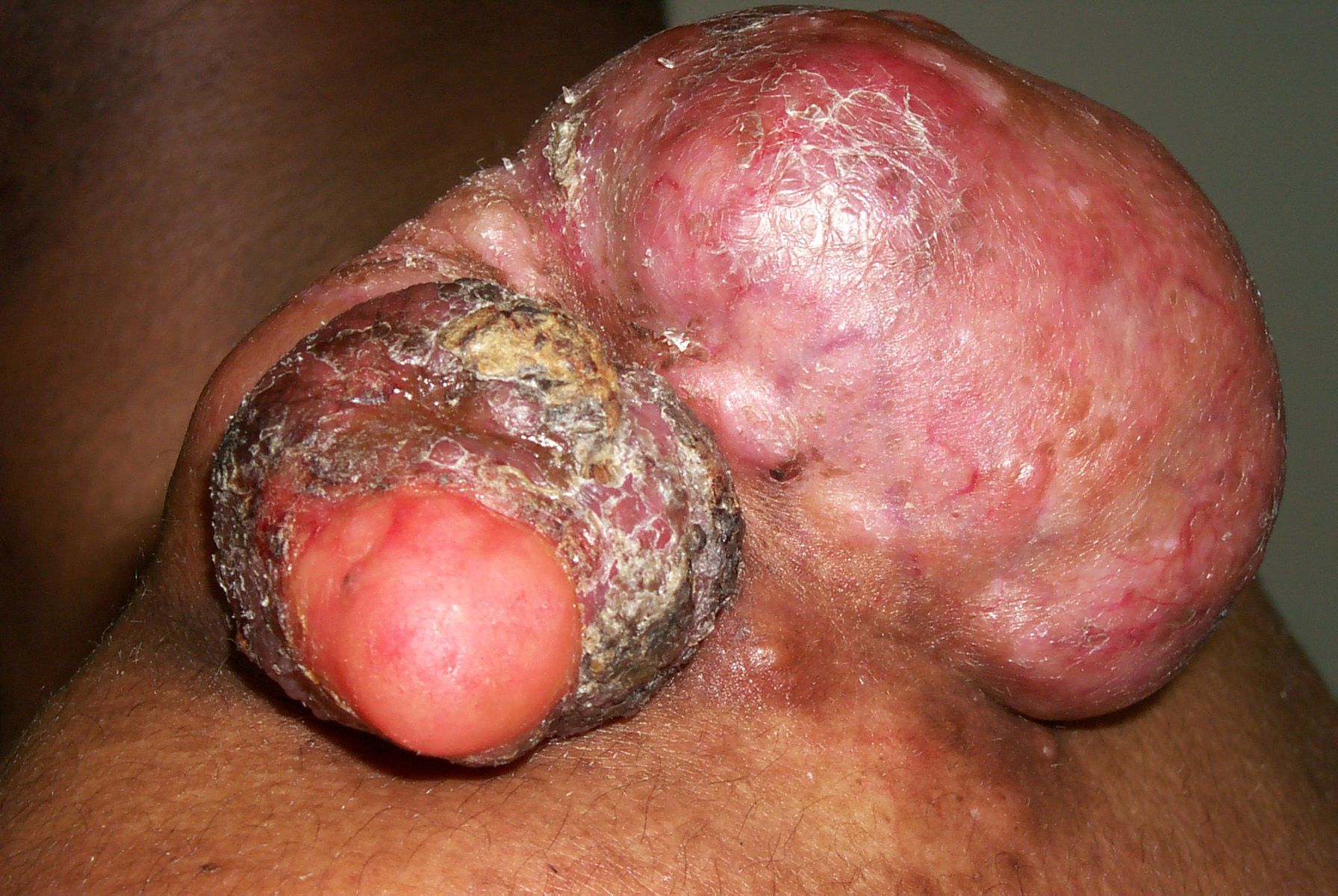 Dermatofibroma