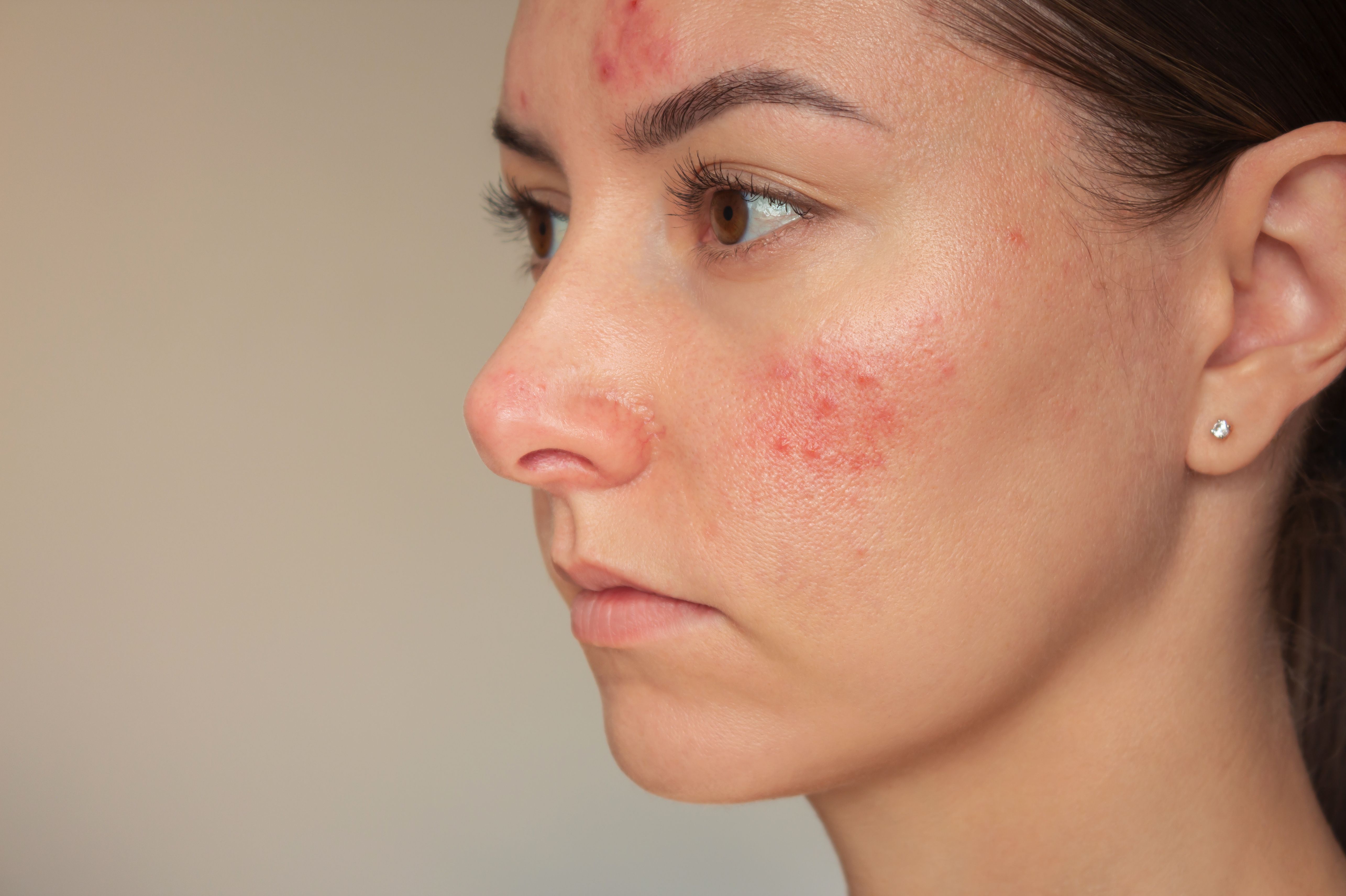 Patients with Rosacea are More Likely to Develop Anxiety and Depression