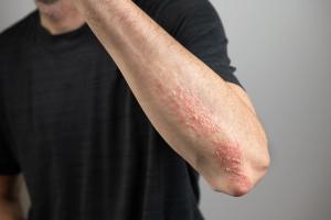 Oral IL-23 Blocker Shows Durable Psoriasis Control at 1 Year