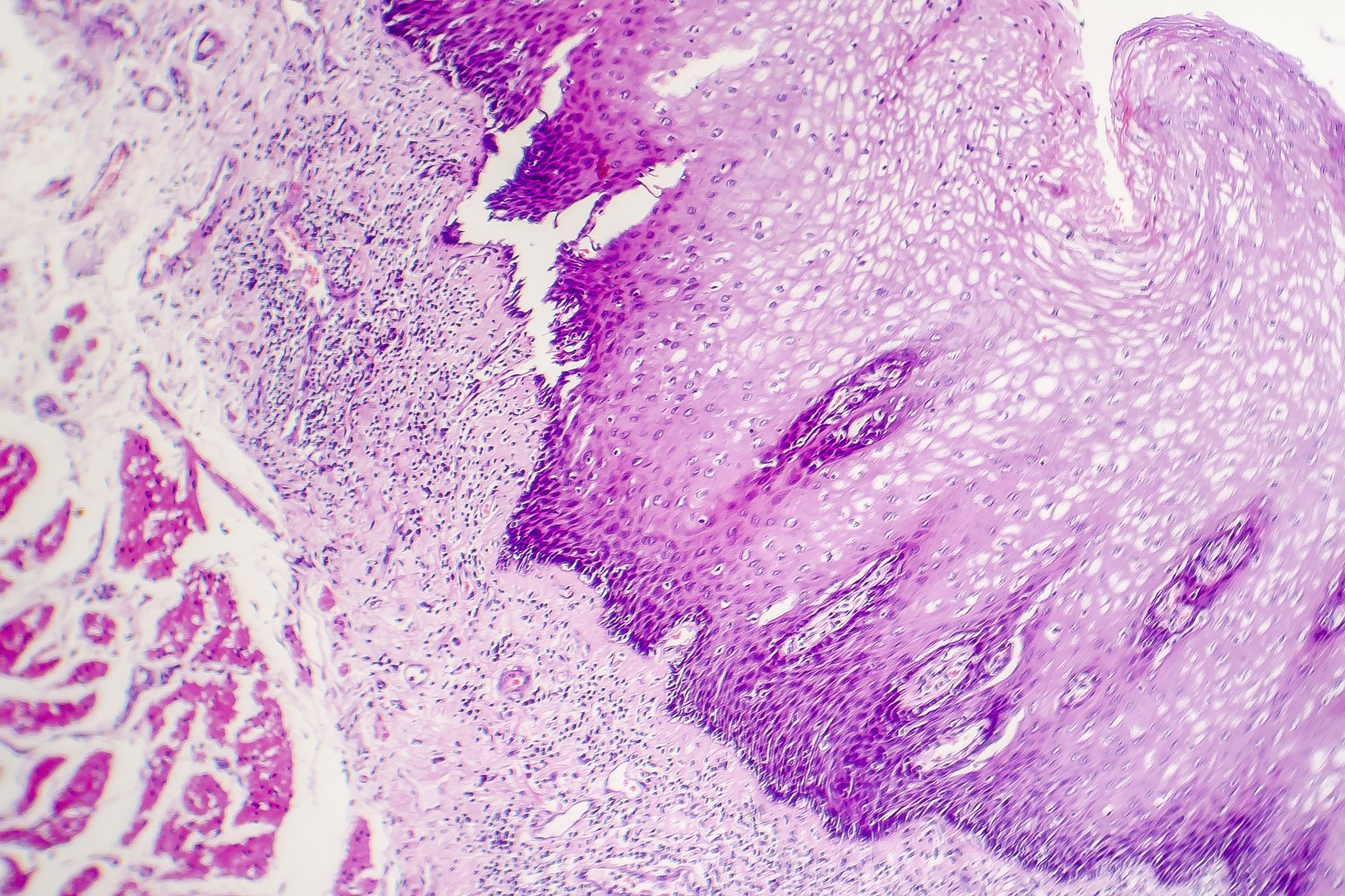 Mortality high in squamous cell carcinoma in hidradenitis