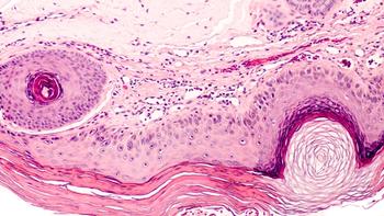 Actinic Keratosis