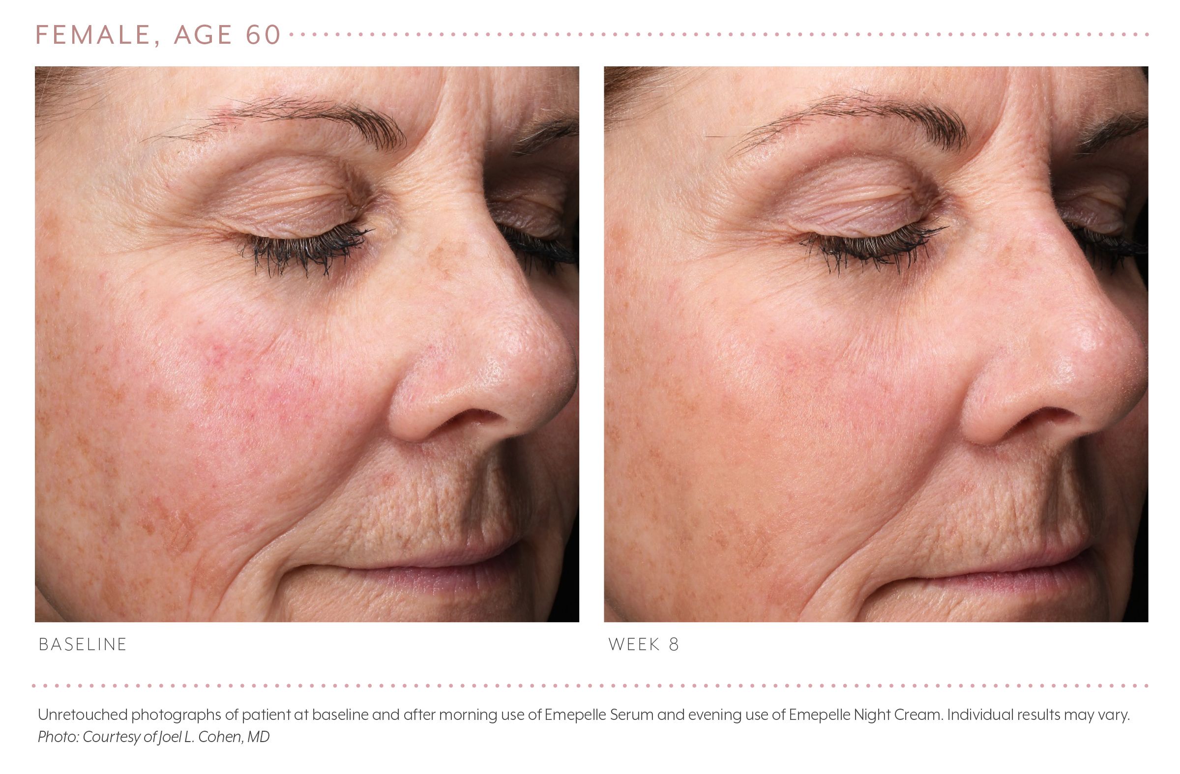 A Solution For Estrogen deficient Skin a-solution-for-estrogen-deficient-skin