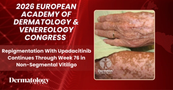 Repigmentation With Upadacitinib Continues Through Week 76 in Non-Segmental Vitiligo