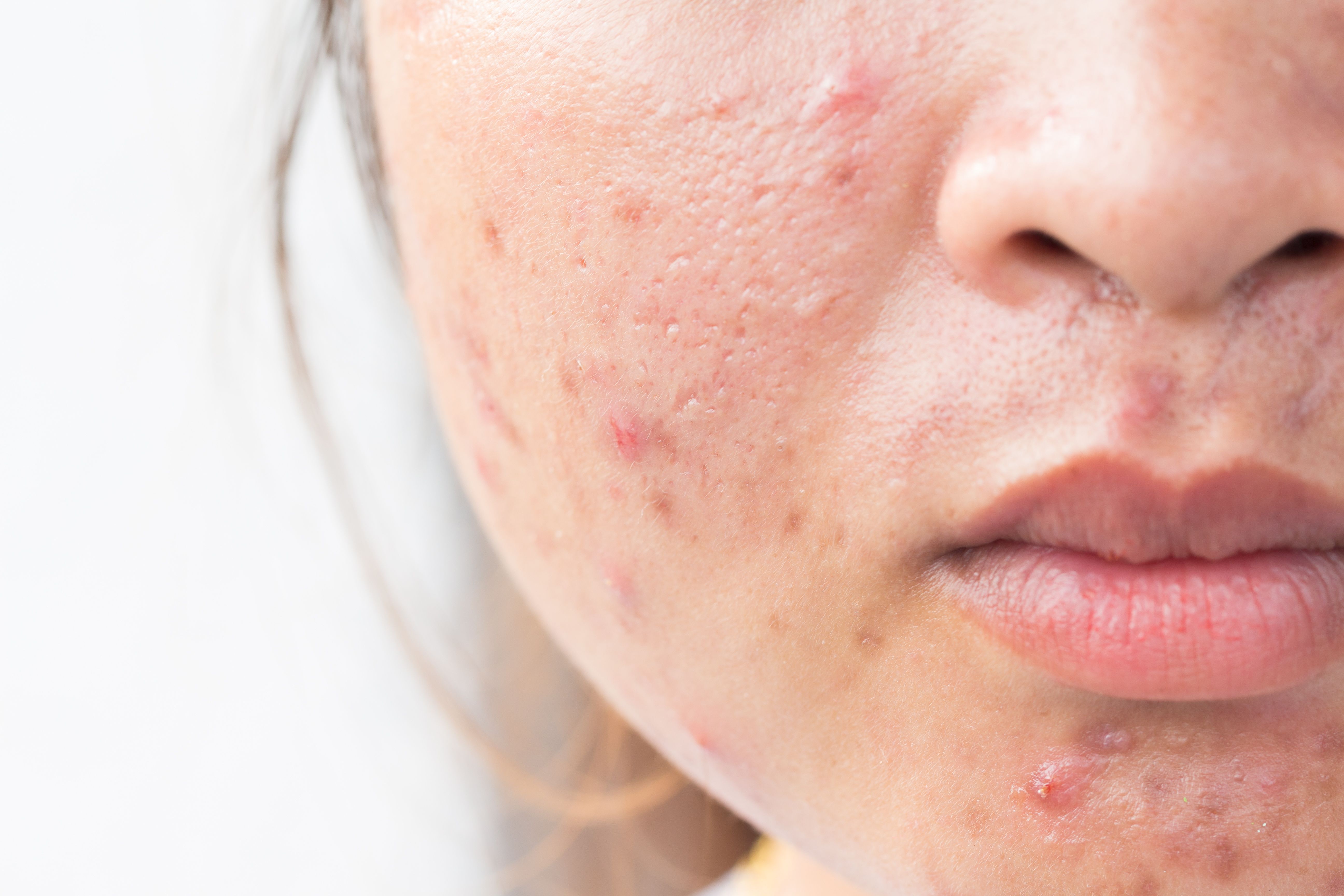 Twyneo Receives FDA Approval for Acne