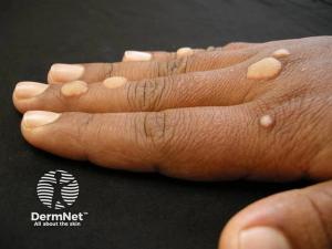 Ycanth Phase 3 Trial Dosing Begins for Common Warts in US, Japan