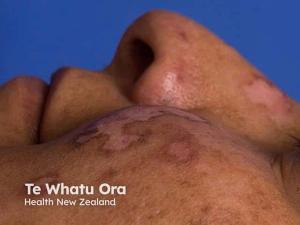 Advancing Equity, Precision, and Awareness in Dermatology