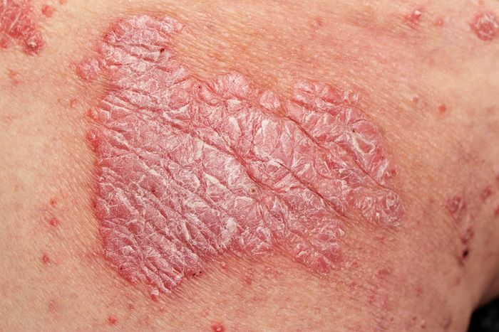 Detail of psoriatic skin disease with narrow focus, skin patches are typically red, itchy, and scaly